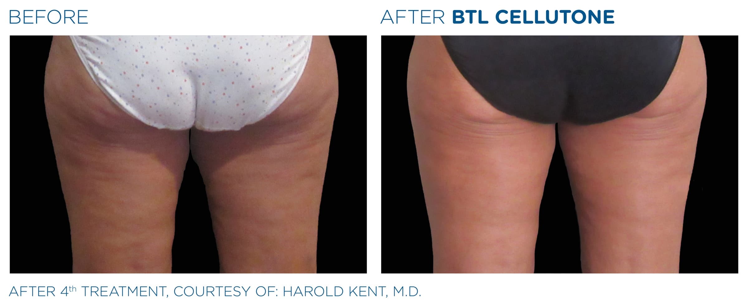 Before-and-after composite from BTL's clinical library showing thighs treated with CELLUTONE in combination with non-invasive body shaping therapy.