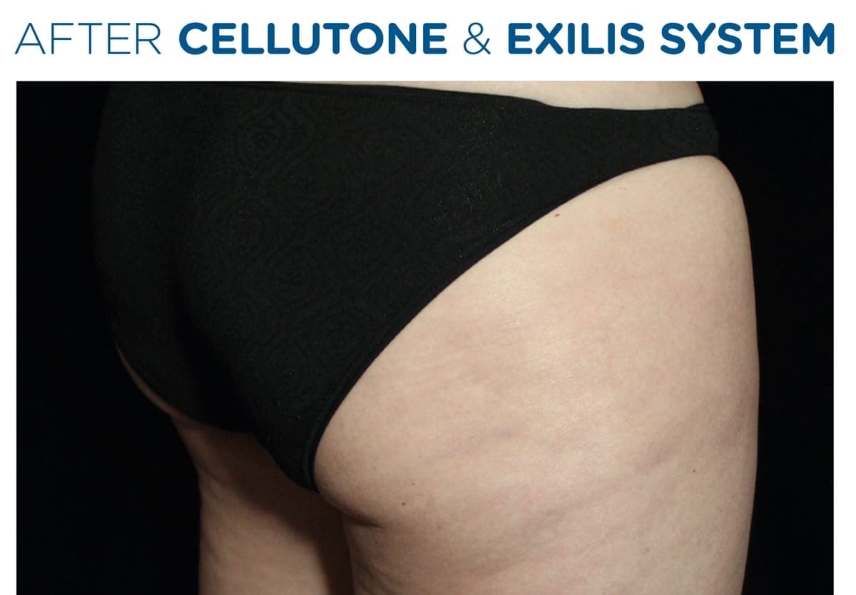 Before-and-after of a female patient's buttock area treated with CELLUTONE combined with Exilis radiofrequency therapy. — after