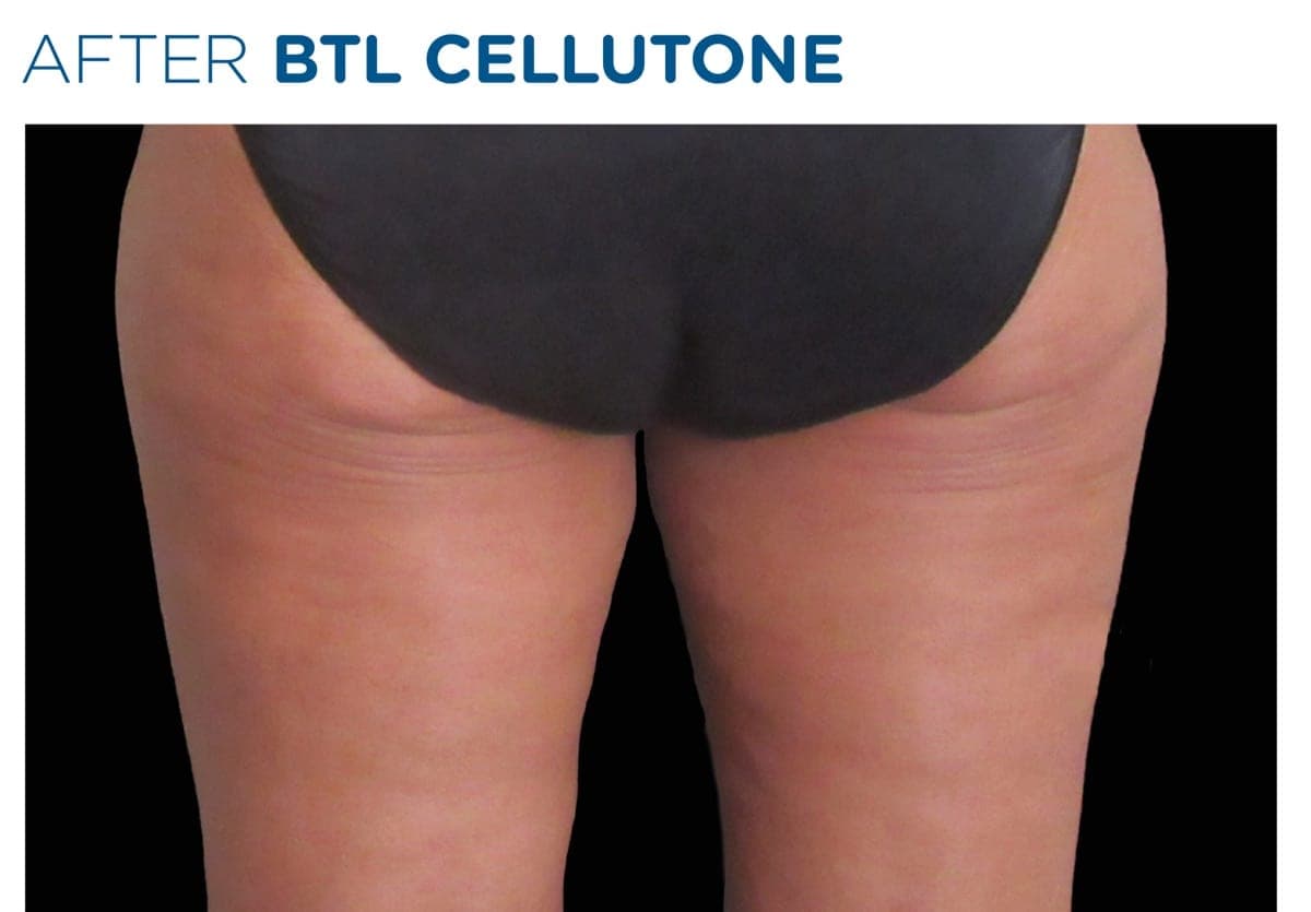 Before-and-after of a female patient's thighs treated with CELLUTONE alongside non-invasive body-shaping therapy, from BTL's clinical library. — after