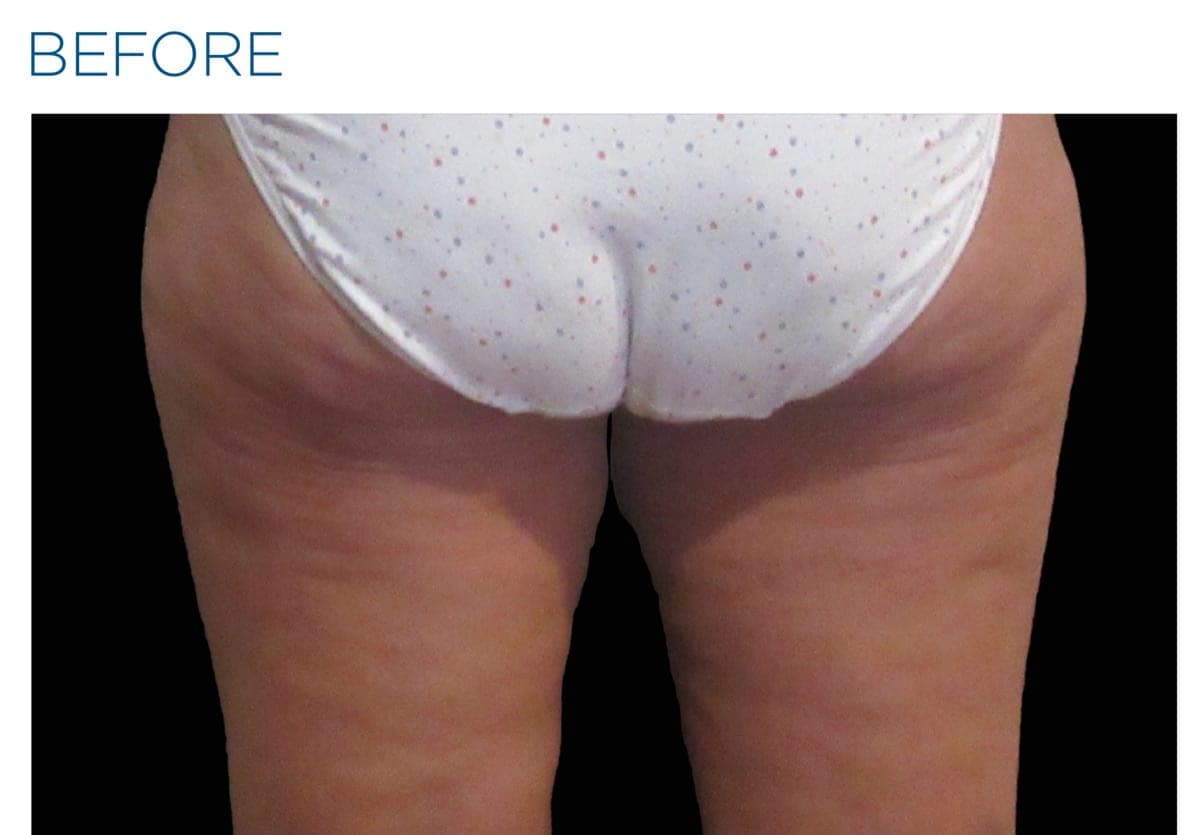 Before-and-after of a female patient's thighs treated with CELLUTONE alongside non-invasive body-shaping therapy, from BTL's clinical library. — before