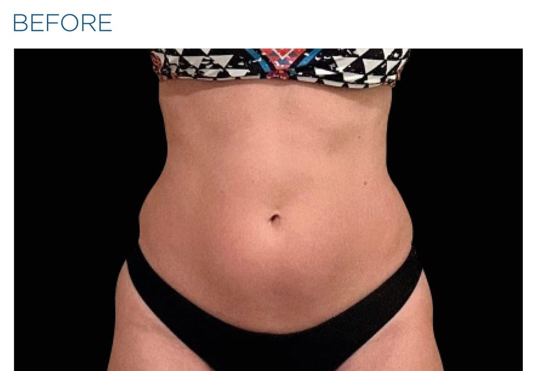 Before and after EMSCULPT NEO treatment of the female abdomen — improved tone and reduced circumference. — before