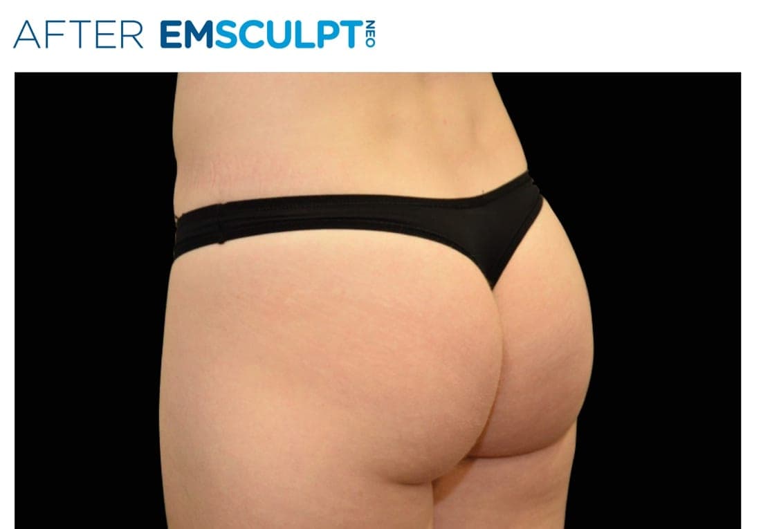 Before and after EMSCULPT NEO treatment of the female buttocks — firming and toning. — after