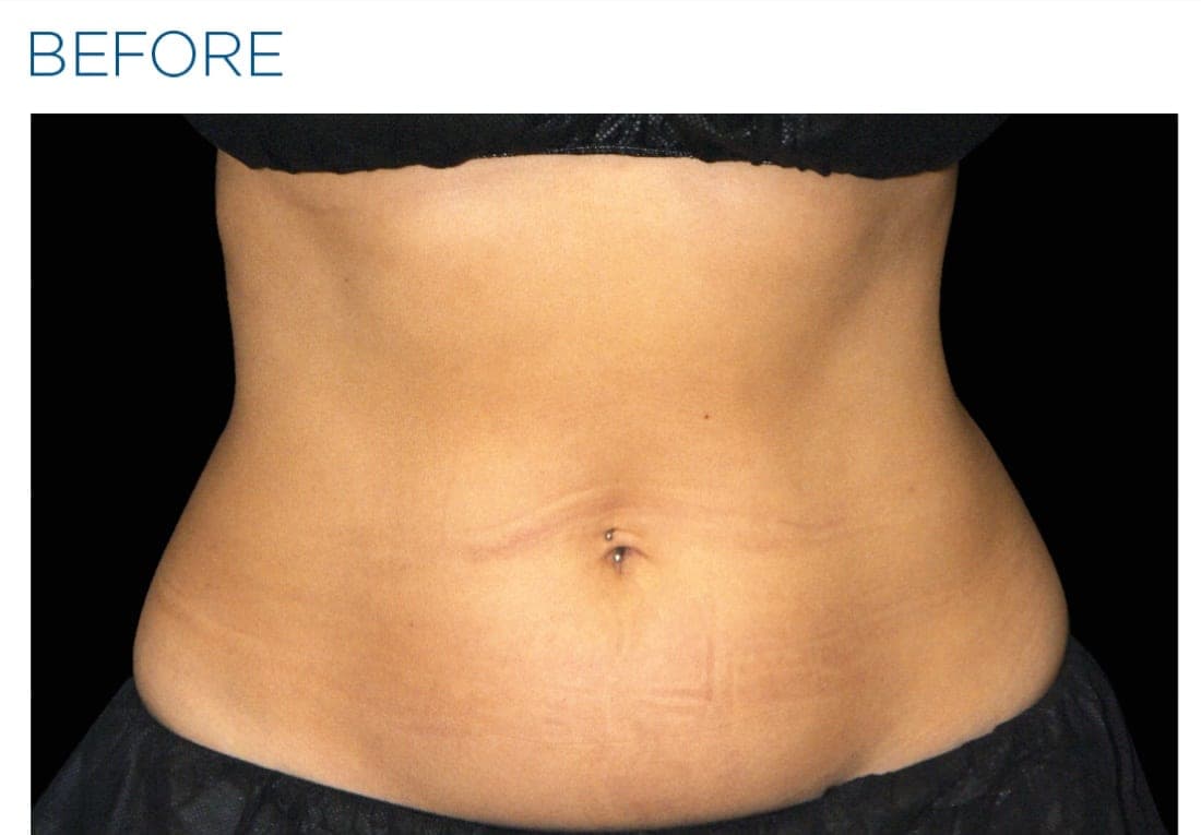 Before and after EMSCULPT NEO treatment of the female lateral abdomen and flanks. — before